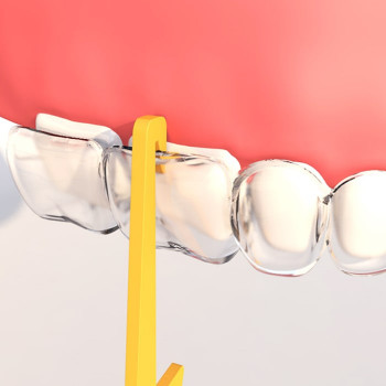 Крючок для снятия кап/элайнеров Orthodontic Aligner Remover / Y-Kelin2